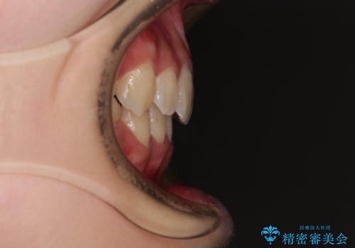 ワイヤー装置の抜歯矯正で横顔のシルエットをすっきりとの治療後