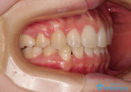 ワイヤー装置の抜歯矯正で横顔のシルエットをすっきりとの治療後