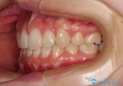 ワイヤー装置の抜歯矯正で横顔のシルエットをすっきりとの治療後