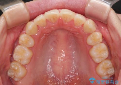 ワイヤー装置の抜歯矯正で横顔のシルエットをすっきりとの治療後