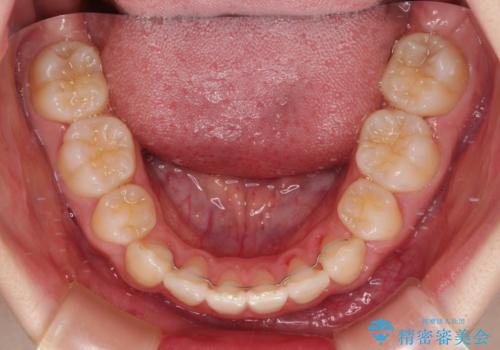 ワイヤー装置の抜歯矯正で横顔のシルエットをすっきりとの治療後