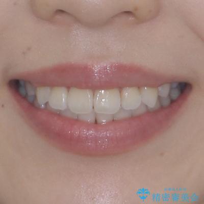舌突出癖による開咬　舌のトレーニングを行いながら前歯の隙間を改善の治療後（顔貌）