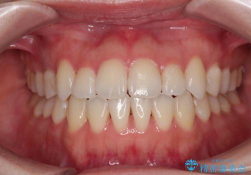 舌突出癖による開咬　舌のトレーニングを行いながら前歯の隙間を改善の症例 治療後
