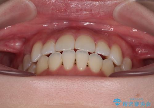 舌突出癖による開咬 舌のトレーニングを行いながら前歯の隙間を改善の治療後