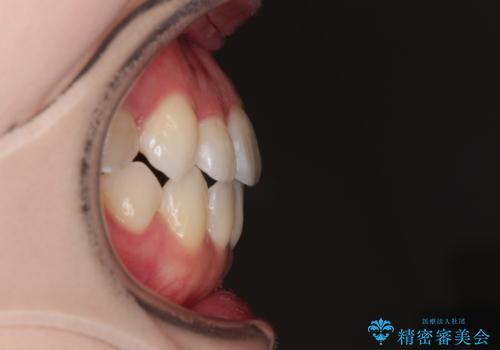 舌突出癖による開咬 舌のトレーニングを行いながら前歯の隙間を改善の治療後