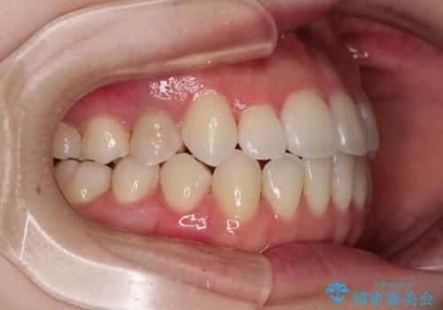 舌突出癖による開咬 舌のトレーニングを行いながら前歯の隙間を改善の治療後