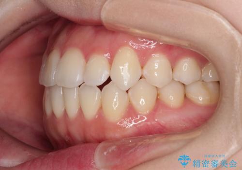 舌突出癖による開咬　舌のトレーニングを行いながら前歯の隙間を改善の治療後