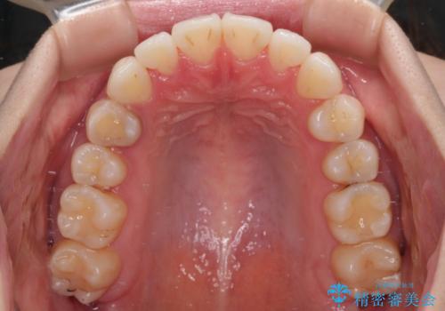 舌突出癖による開咬 舌のトレーニングを行いながら前歯の隙間を改善の治療後
