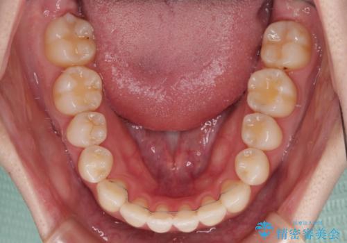 舌突出癖による開咬　舌のトレーニングを行いながら前歯の隙間を改善の治療後