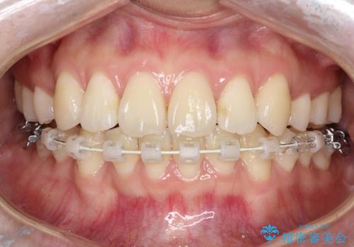 裏側矯正でEラインを改善! すっきりした口元に!の治療中