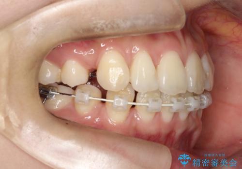 裏側矯正でEラインを改善! すっきりした口元に!の治療中