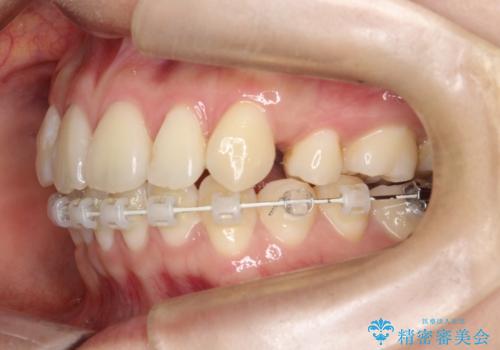 裏側矯正でEラインを改善! すっきりした口元に!の治療中