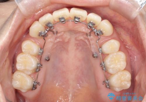 裏側矯正でEラインを改善! すっきりした口元に!の治療中