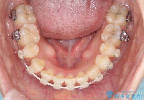 裏側矯正でEラインを改善! すっきりした口元に!の治療中