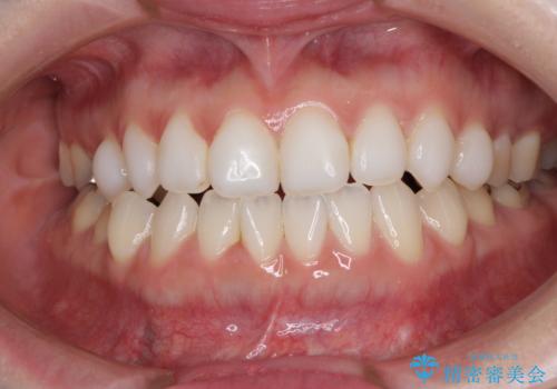 前歯のデコボコをすっきりと インビザライン矯正の症例 治療前