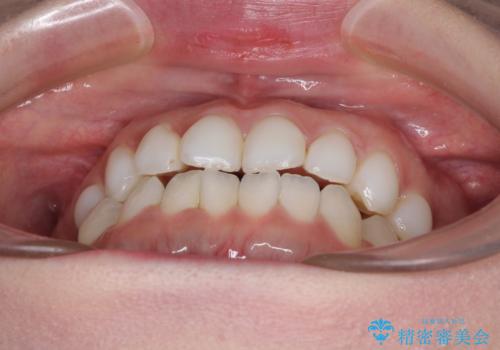 前歯のデコボコをすっきりと　インビザライン矯正の治療前