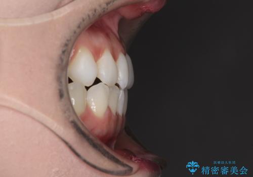 前歯のデコボコをすっきりと インビザライン矯正の治療前
