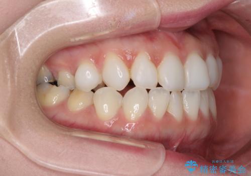 前歯のデコボコをすっきりと インビザライン矯正の治療前