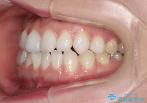 前歯のデコボコをすっきりと　インビザライン矯正の治療前