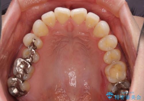 前歯のデコボコをすっきりと インビザライン矯正の治療前