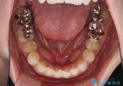 前歯のデコボコをすっきりと インビザライン矯正の治療前