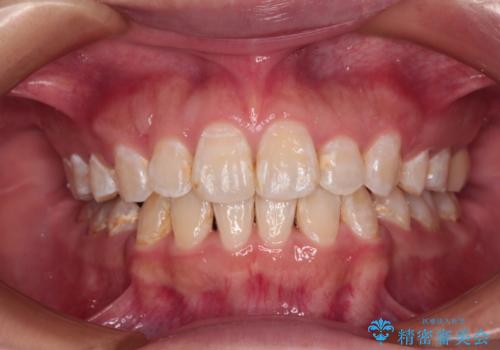 口が閉じにくい　ワイヤー装置での抜歯矯正の症例 治療後