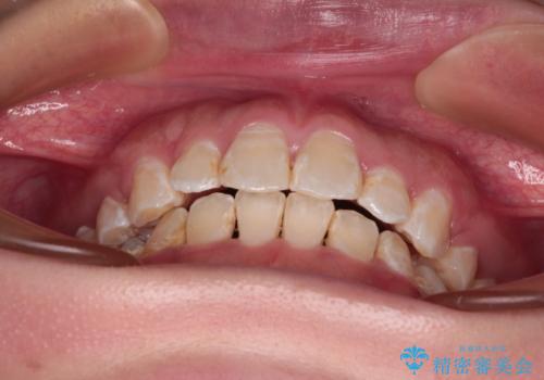 口が閉じにくい　ワイヤー装置での抜歯矯正の治療後