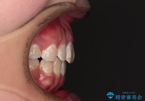 口が閉じにくい ワイヤー装置での抜歯矯正の治療後