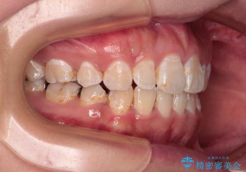 口が閉じにくい ワイヤー装置での抜歯矯正の治療後