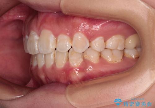 口が閉じにくい ワイヤー装置での抜歯矯正の治療後