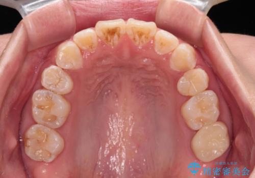 口が閉じにくい ワイヤー装置での抜歯矯正の治療後