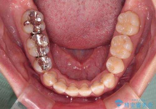 口が閉じにくい ワイヤー装置での抜歯矯正の治療後