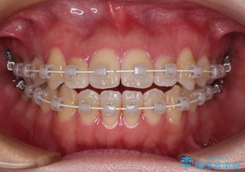 舌突出癖による開咬 舌のトレーニングを行いながら前歯の隙間を改善の治療中