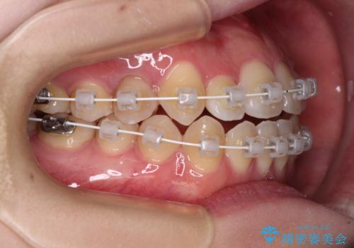 舌突出癖による開咬 舌のトレーニングを行いながら前歯の隙間を改善の治療中