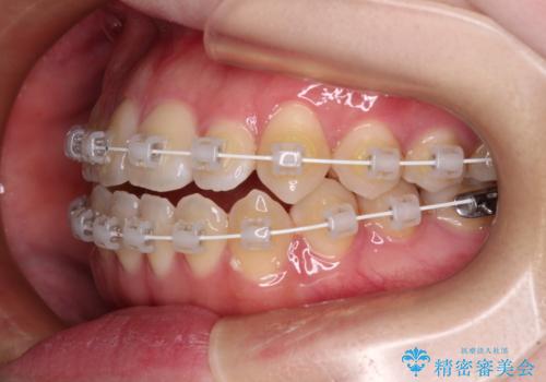 舌突出癖による開咬 舌のトレーニングを行いながら前歯の隙間を改善の治療中