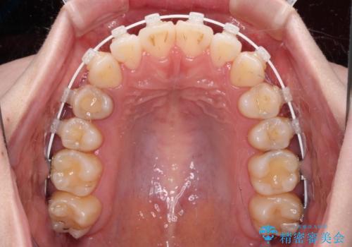 舌突出癖による開咬　舌のトレーニングを行いながら前歯の隙間を改善の治療中