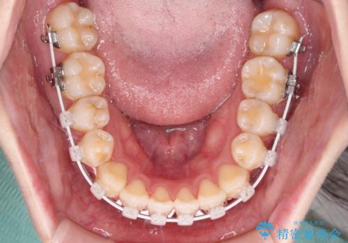 舌突出癖による開咬 舌のトレーニングを行いながら前歯の隙間を改善の治療中