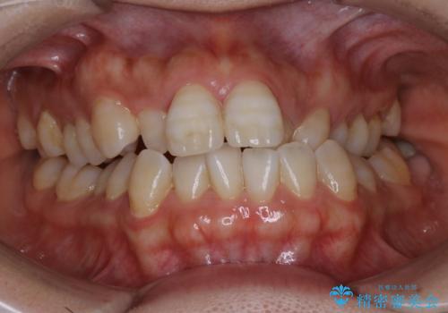 インビザライン、非抜歯でここまでできる。補助装置との組み合わせで顎のゆがみとかみ合わせを治すの治療前