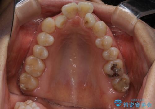 インビザライン、非抜歯でここまでできる。補助装置との組み合わせで顎のゆがみとかみ合わせを治すの治療前