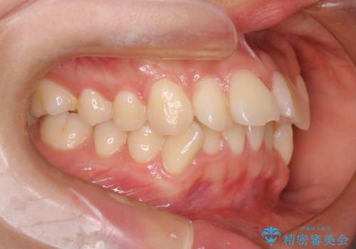 裏側矯正でEラインを改善! すっきりした口元に!の治療前