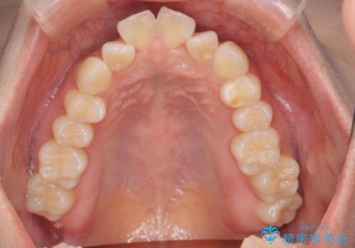 裏側矯正でEラインを改善! すっきりした口元に!の治療前