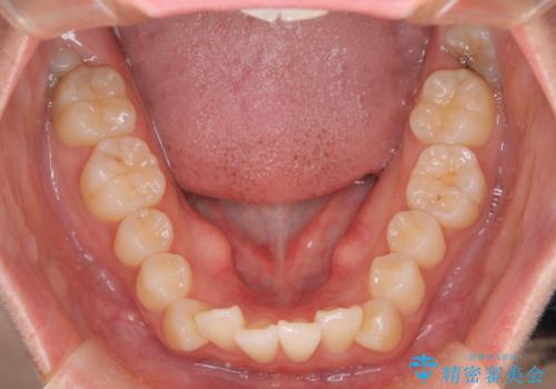 裏側矯正でEラインを改善! すっきりした口元に!の治療前