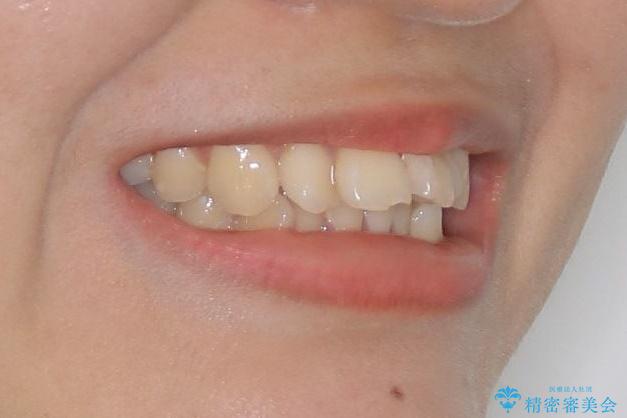 裏側矯正でEラインを改善! すっきりした口元に!の治療前(顔貌)