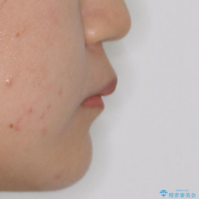 裏側矯正でEラインを改善! すっきりした口元に!の治療前(顔貌)