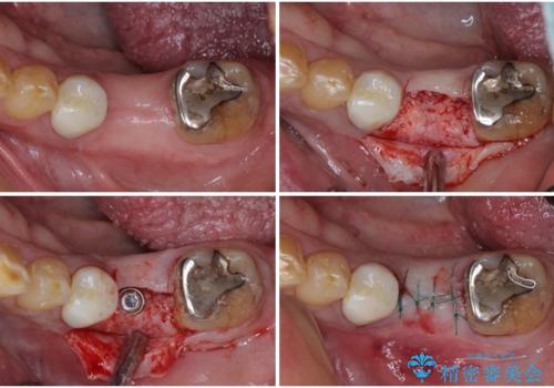 割れてしまった奥歯 インプラントによる補綴治療の治療中
