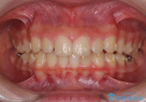 海外で始めたインビザライン 転医手続きにより治療を継続の症例 治療前