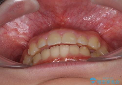 海外で始めたインビザライン 転医手続きにより治療を継続の治療前