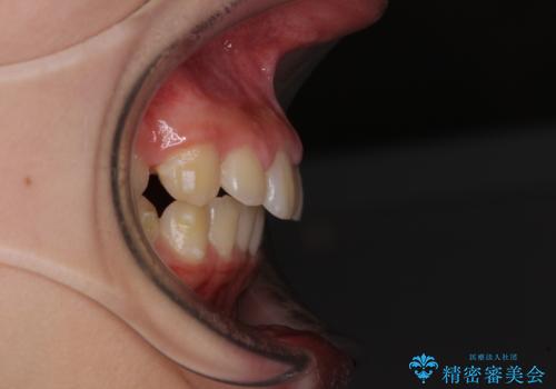 海外で始めたインビザライン 転医手続きにより治療を継続の治療前