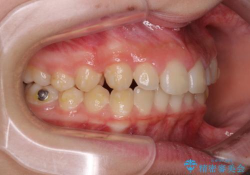 海外で始めたインビザライン 転医手続きにより治療を継続の治療前