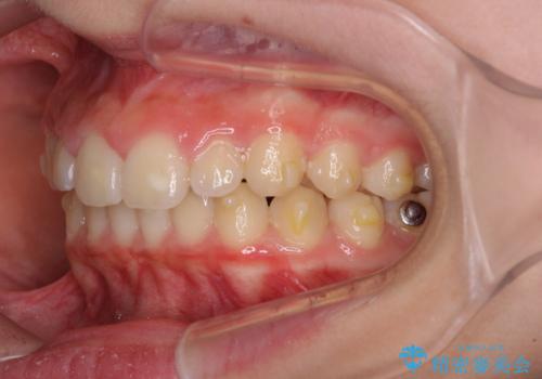 海外で始めたインビザライン 転医手続きにより治療を継続の治療前